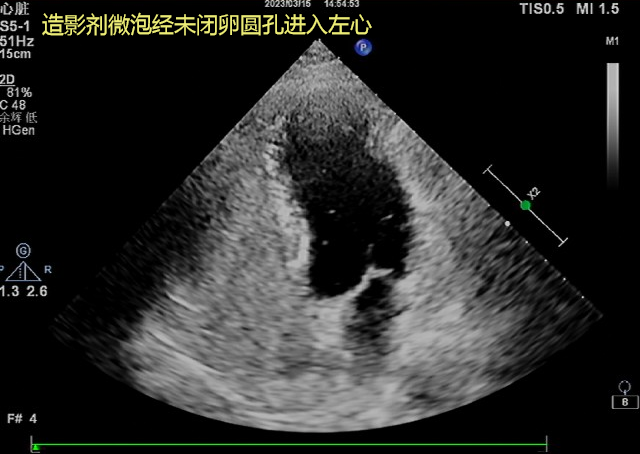 造影剂微泡经未闭卵圆孔进入左心.png